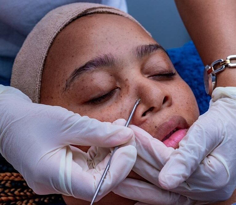 Why Facial Extractions Should Be Done Professionally
