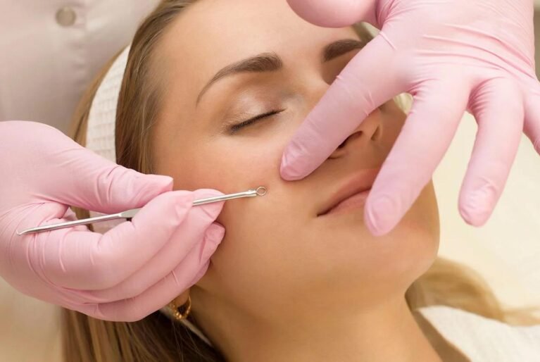 Why Facial Extractions Should Be Done Professionally